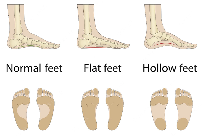 Tips for Running If You're Flat Footed - Every Second Counts